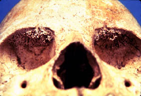 skull with symptoms of malnutrition